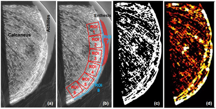 The Correlation between the Elastic Modulus of the Achilles Tendon Enthesis and Bone Microstructure in the Calcaneal Crescent.
