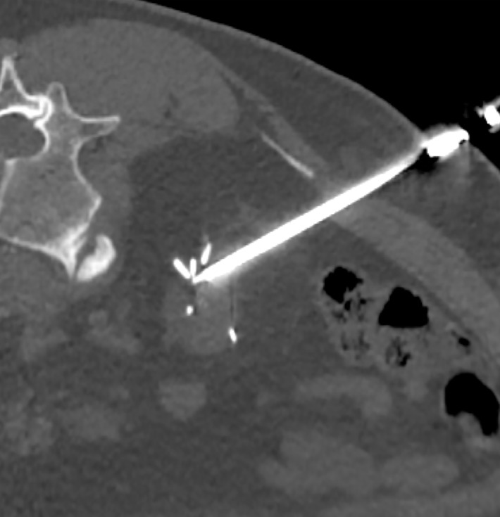 Percutaneous cryoablation of kidney tumors after partial nephrectomy.