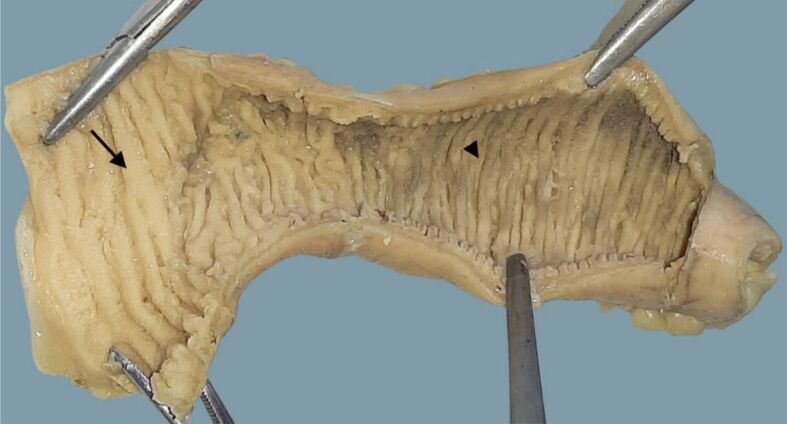 Adenocarcinoma of the ileum: literature insights on pyloric gland metaplasia.