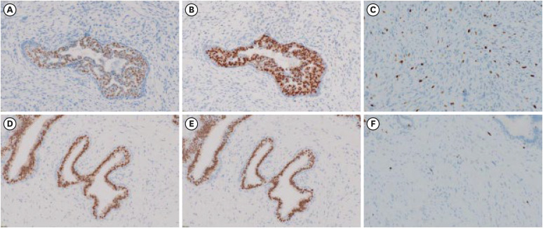 Histopathological Downgrading of Borderline Phyllodes Tumor in a Young Patient Following Chemotherapy: A Case Report.