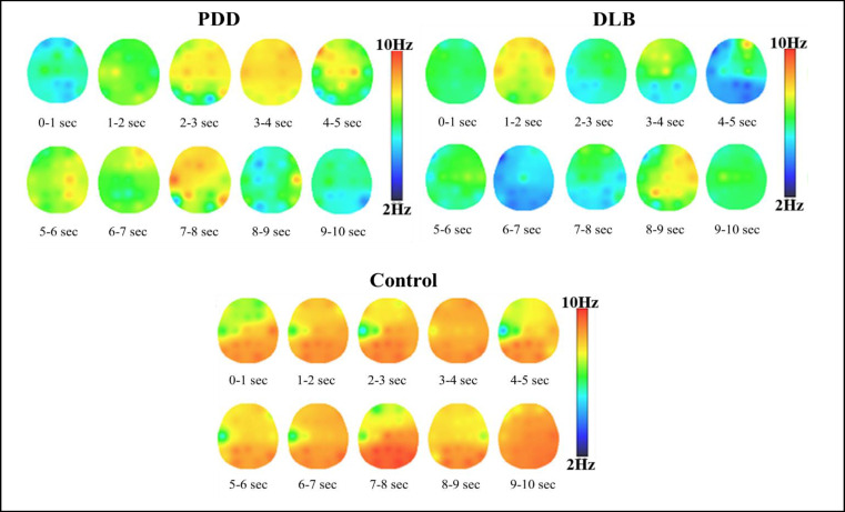 Comparison of Brain Activity between Patients with Parkinson Disease Dementia and Patients Affected by Dementia with Lewy Body through EEG Analysis.