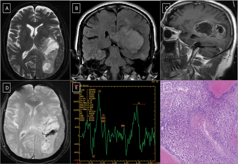 Role of Advanced Magnetic Resonance Imaging in Differentiating among Glioma Subtypes and Predicting Tumor-Proliferative Behavior.