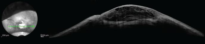 Conjunctival Collagen Cross-Linking for the Treatment of Leaking Avascular Cystic Bleb.