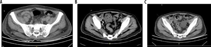 Application of ultrasound-guided intranodal lymphangiography in the diagnosis and treatment of chylous ascites after abdominal surgery.