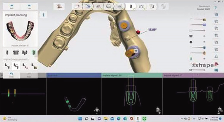 Impact of type and position of abutment connection on microstrain distribution: an <i>in vitro</i> study.