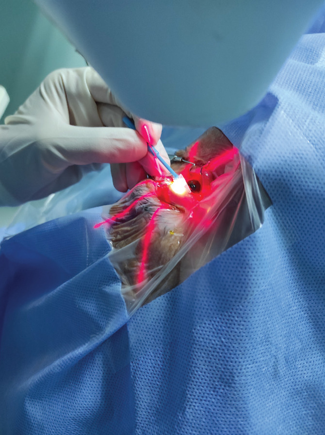 Conjunctival Collagen Cross-Linking for the Treatment of Leaking Avascular Cystic Bleb.