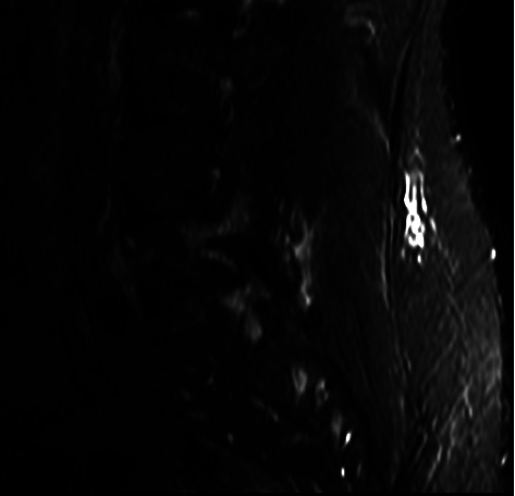 Association Between MRI Findings of Facet Arthropathy and Synovitis With Health-Related Outcome and Pain Scores Following Therapeutic Lumbar Facet Injections.