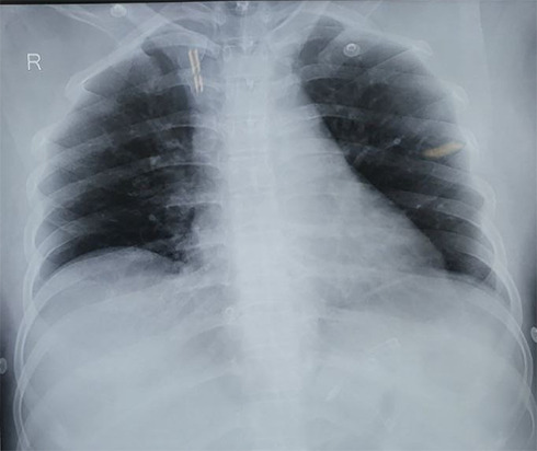 Cartap Poisoning with Paroxysmal Supraventricular Tachycardia: A Case Report.