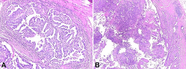 Adenocarcinoma of the ileum: literature insights on pyloric gland metaplasia.