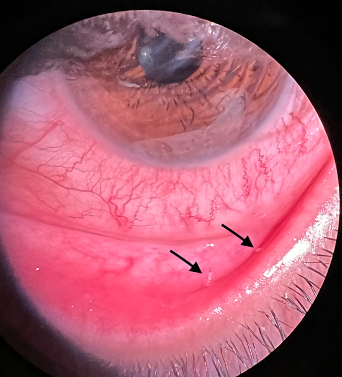Ophthalmomyiasis Externa: A Case Report in a Tertiary Care Center in Riyadh, Saudi Arabia.