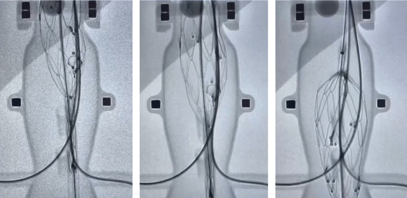 Sliding Rail Technique (Mandelli's), a Better Method to Repair Thoracoabdominal Aortic Aneurysms Controlled Release Fenestrated Endoprosthesis.