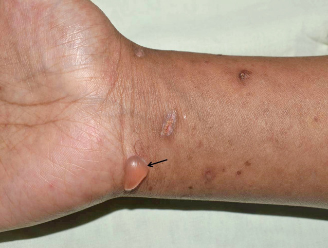 Bullous Cutaneous Lupus Erythematosus and Class V Lupus Nephritis: Rare Concurrence.