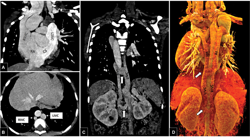 Persistent Levoatriocardinal Vein in Association with Complete Duplication of SVC and IVC.