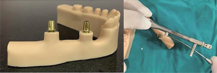 Impact of type and position of abutment connection on microstrain distribution: an <i>in vitro</i> study.