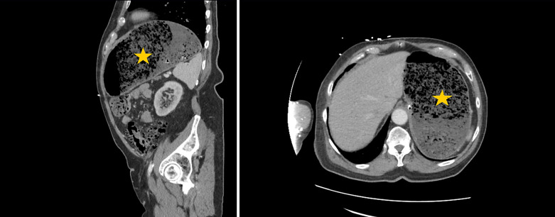 Acute Gastric Dilatation: A Retrospective Case Series from a Single Institution.