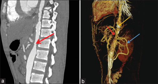 Intestinal Ischemia Unveiling Takayasu Arteritis: A Rare Encounter.