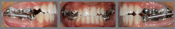 Facial soft tissue changes in adolescent patients treated with three different functional appliances: a randomized clinical trial.