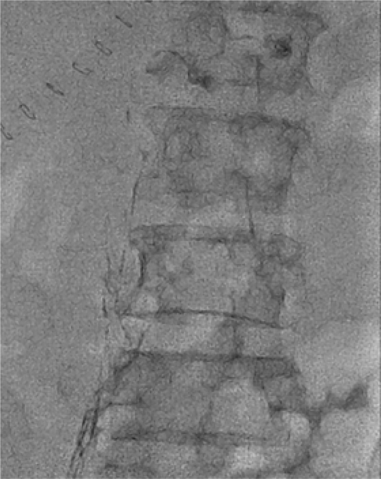 Application of ultrasound-guided intranodal lymphangiography in the diagnosis and treatment of chylous ascites after abdominal surgery.
