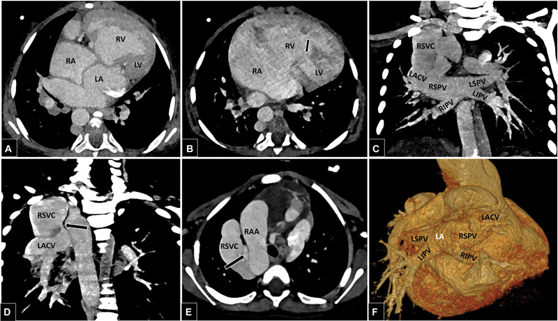 Persistent Levoatriocardinal Vein in Association with Complete Duplication of SVC and IVC.