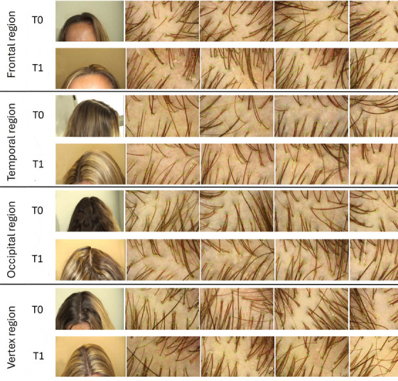 Shock Waves for Hair Growth and Regeneration in Patients With Female Pattern Hair Loss.