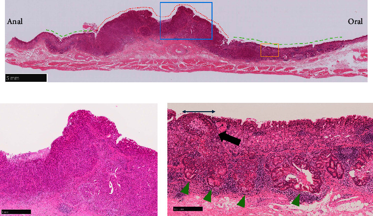White Globe Appearance-Like Findings Indicating Intralymphatic Cancer Involvement Beneath the Epithelium in Gastric Cancer.