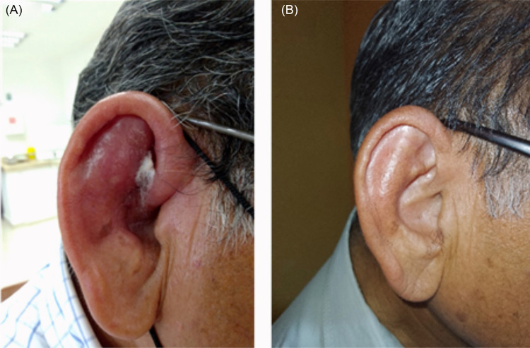 First case of urban leishmaniasis in the Campeche State, Mexico.