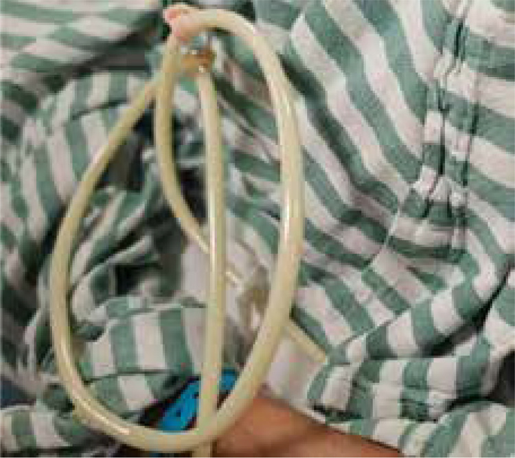 Application of ultrasound-guided intranodal lymphangiography in the diagnosis and treatment of chylous ascites after abdominal surgery.