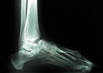 From Etiology to Intervention: A Holistic Review of Bunion Pathophysiology and Care.