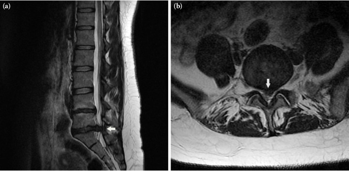 Rehabilitation in a case with cauda equina syndrome after spinal manipulation: A long and difficult process.
