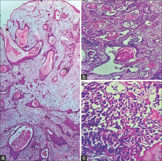 Pleomorphic adenoma with extensive squamous metaplasia and keratinizing cysts: Diagnostic and clinical pitfalls - A report of two cases and review of literature.