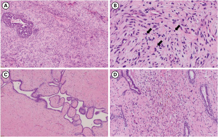 Histopathological Downgrading of Borderline Phyllodes Tumor in a Young Patient Following Chemotherapy: A Case Report.