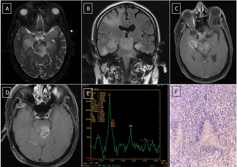 Role of Advanced Magnetic Resonance Imaging in Differentiating among Glioma Subtypes and Predicting Tumor-Proliferative Behavior.