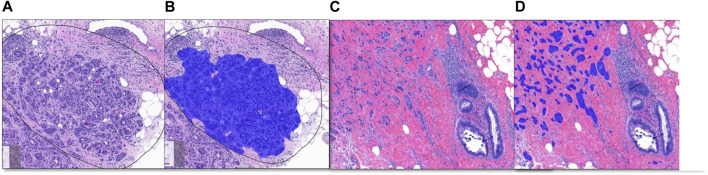 Artificial intelligence-based automated determination in breast and colon cancer and distinction between atypical and typical mitosis using a cloud-based platform.