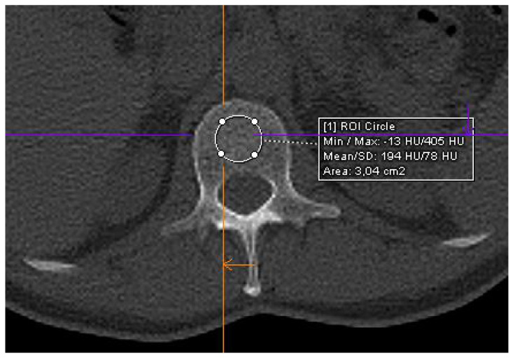 Trabecular Attenuation of L1 in Adult Patients with Multiple Myeloma: An Observational Study on Low-Dose CT Images.