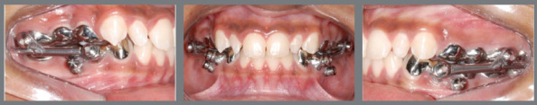Facial soft tissue changes in adolescent patients treated with three different functional appliances: a randomized clinical trial.