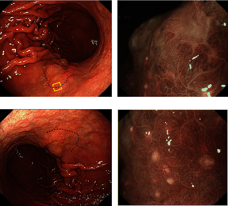White Globe Appearance-Like Findings Indicating Intralymphatic Cancer Involvement Beneath the Epithelium in Gastric Cancer.