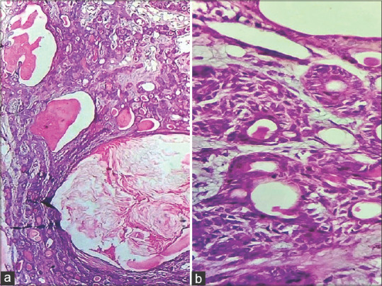 Pleomorphic adenoma with extensive squamous metaplasia and keratinizing cysts: Diagnostic and clinical pitfalls - A report of two cases and review of literature.