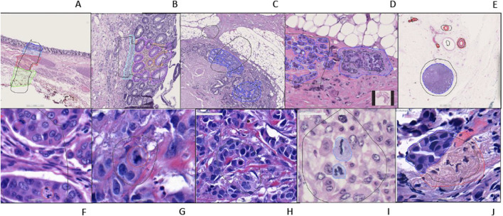 Artificial intelligence-based automated determination in breast and colon cancer and distinction between atypical and typical mitosis using a cloud-based platform.