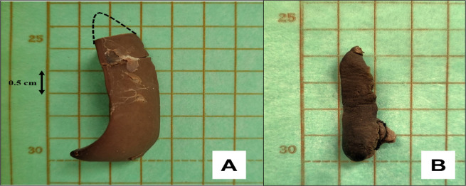Molecular Tracking of <i>Leishmania major</i> in an Archived <i>Rattus norvegicus</i> Spleen Sample in Iran: A Case Report.