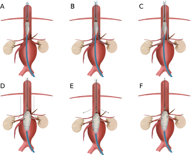 Sliding Rail Technique (Mandelli's), a Better Method to Repair Thoracoabdominal Aortic Aneurysms Controlled Release Fenestrated Endoprosthesis.