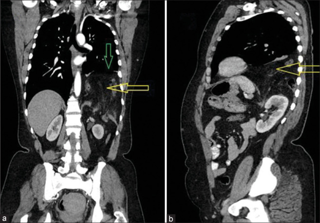 Spontaneous Acquired Diaphragmatic Hernia: Case Series and Review of Literature.