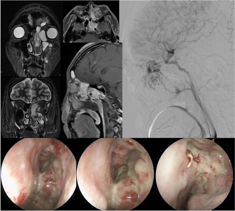 Non-Surgical Management of Recurrent Naso-Orbital Hemangiomas with Bevacizumab: A Case Report.