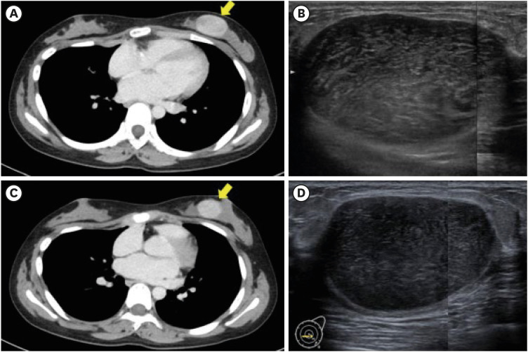 Histopathological Downgrading of Borderline Phyllodes Tumor in a Young Patient Following Chemotherapy: A Case Report.