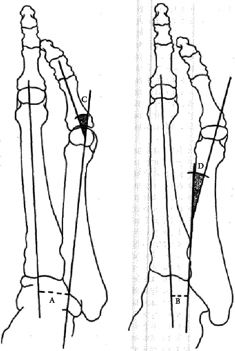 From Etiology to Intervention: A Holistic Review of Bunion Pathophysiology and Care.