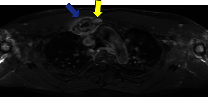 Enteropathic SAPHO Syndrome in Ulcerative Colitis Responsive to Bisphosphonates.