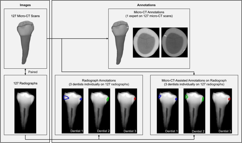 Enhancement of early proximal caries annotations in radiographs: introducing the Diagnostic Insights for Radiographic Early-caries with micro-CT (ACTA-DIRECT) dataset.