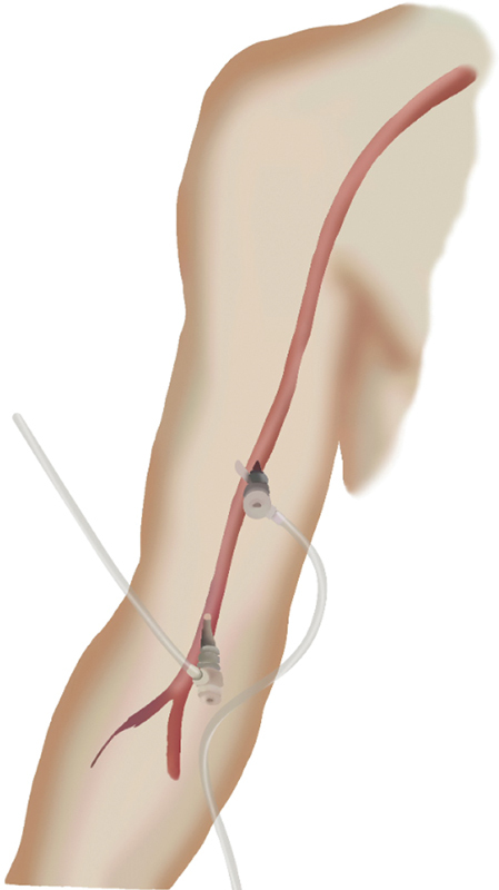 Sliding Rail Technique (Mandelli's), a Better Method to Repair Thoracoabdominal Aortic Aneurysms Controlled Release Fenestrated Endoprosthesis.