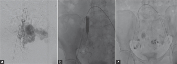 Challenges in the Management of Postmenopausal Uterine Artery Venous Malformation.