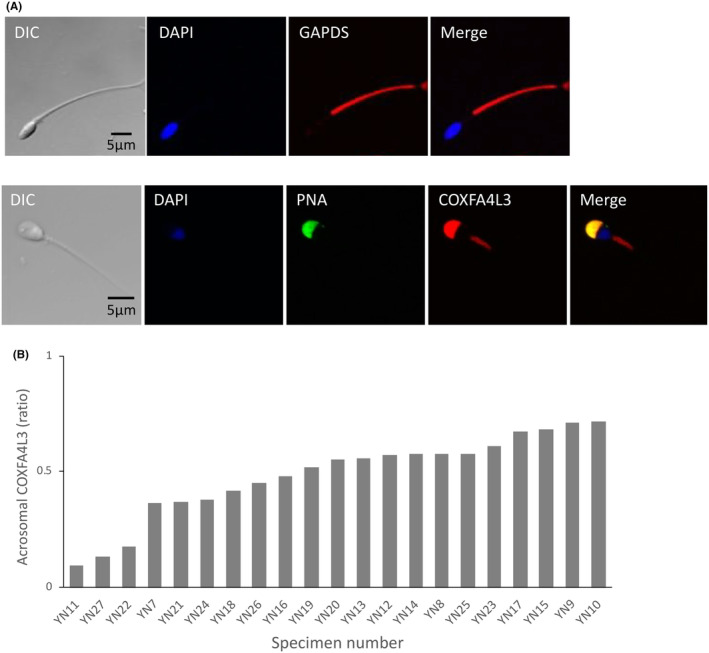 Ectopic expression of the mitochondrial protein COXFA4L3 in human sperm acrosome and its potential application in the selection of male infertility treatments.