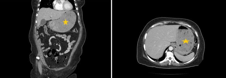Acute Gastric Dilatation: A Retrospective Case Series from a Single Institution.